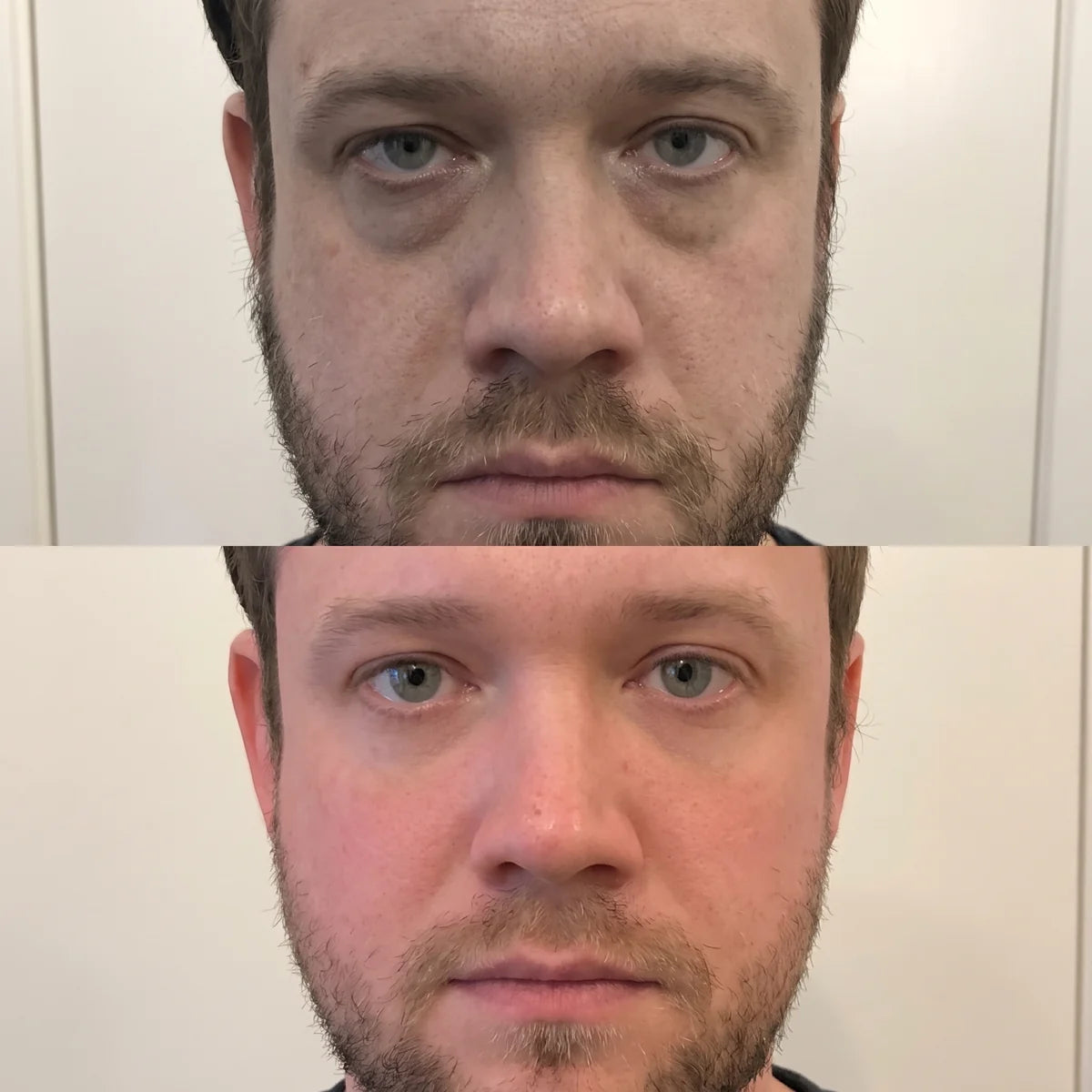 Avant et après : Julien, 33 ans, visage fatigué puis visage reposé après la cure de gommes Sarveni
